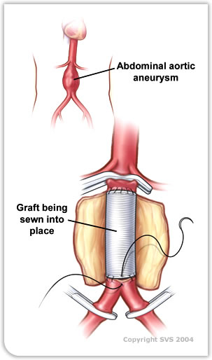 Graft sewn into place for abdominal aortic aneurysm