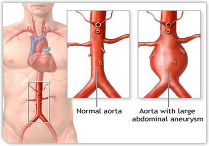 varicose aorta