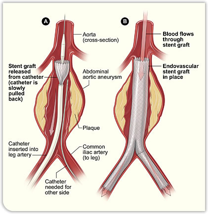 Endovascular Stent Graft