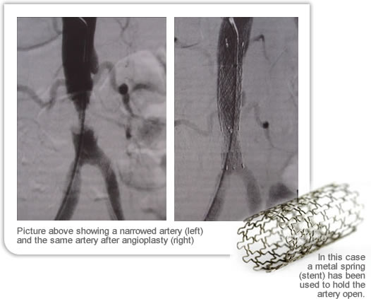 Angioplasty