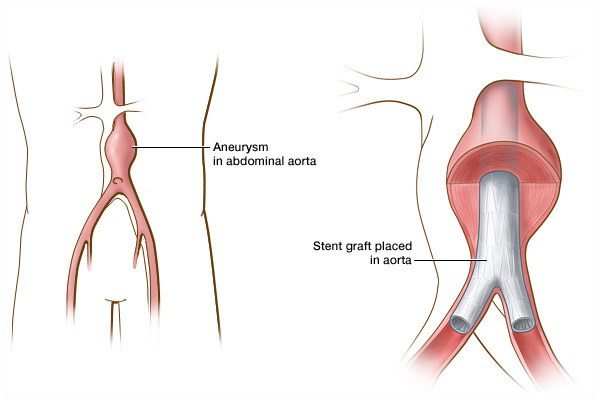 Endovascular Stent Repair Of Abdominal Aneurysm Evar Aortic
