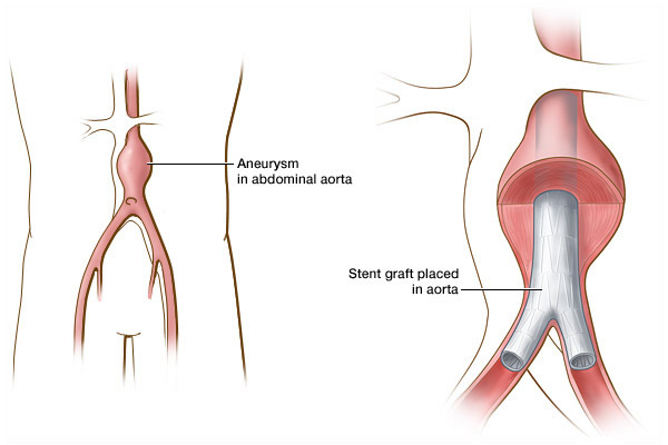 Stent graft in Aorta