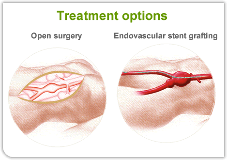 Open operation or an endovascular (keyhole) operation