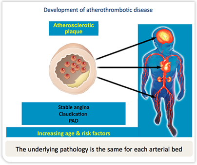 Development of Atherothrombotic Disease - Atherosclerotic Plaque