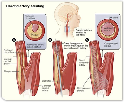 Carotid artery stenting