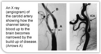 Carotid artery xray