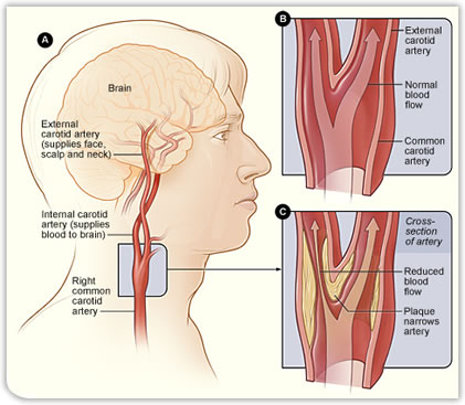 Carotid Arteries