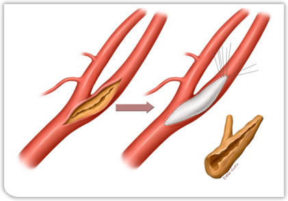 Endarterectomy And Patch Angioplasty