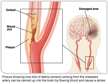 Debris arising from a diseased artery