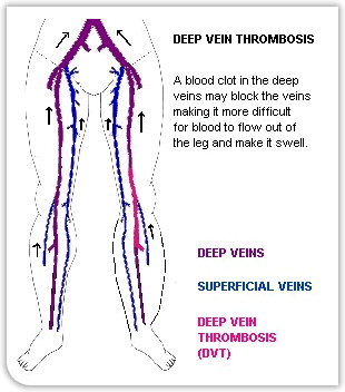 Deep Vein Thrombosis Blood Clot