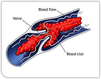 Deep Vein Thrombosis Diagram of Vein