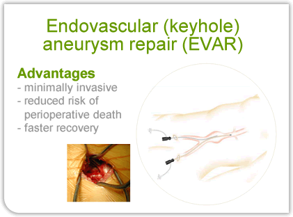 Endovascular keyhole aneurysm repair EVAR