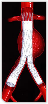 Endovascular Stent Repair