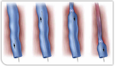 Varicose veins laser treatment