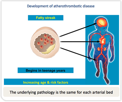 Development of Atherothrombotic Disease - Fatty Streak