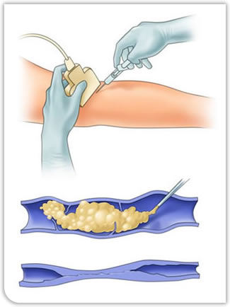 Foam Sclerotherapy