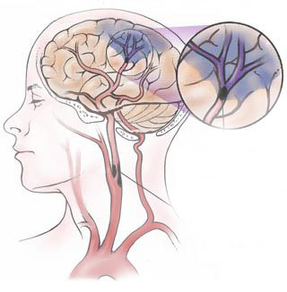 Ischaemic Stroke