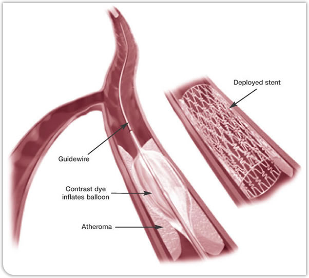 Angioplasty and Stenting