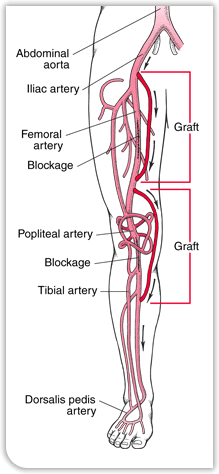 Bypass Surgery on leg arteries