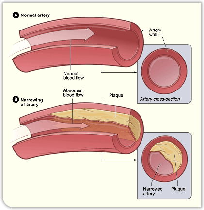 Fatty deposits in wall of the arteries