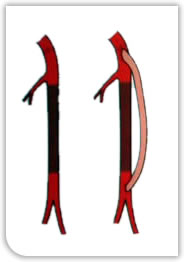 Leg artery bypass