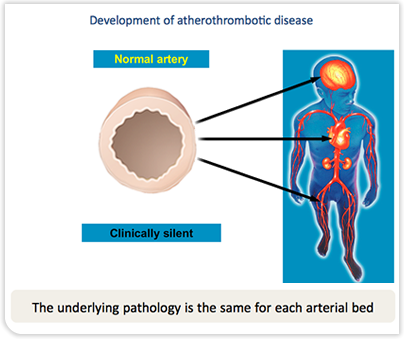 Development of Atherothrombotic Disease - Normal Artery