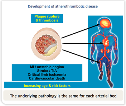 Development of Atherothrombotic Disease - Plaque Rupture and Thrombosis