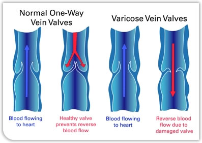 Varicose Vein Valves