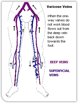 Varicose Veins