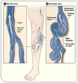 Varicose Veins