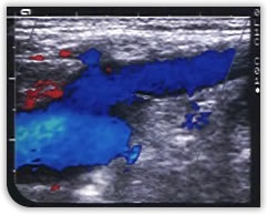 Venous duplex scanning image