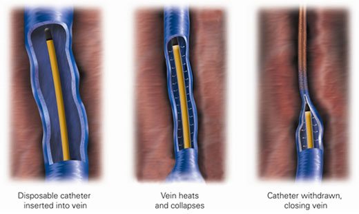VNUS Catheter Ablation